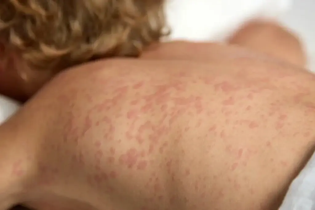 La Secretaría de Salud de Bogotá confirma un caso importado de sarampión procedente de México - Foto: Redes sociales