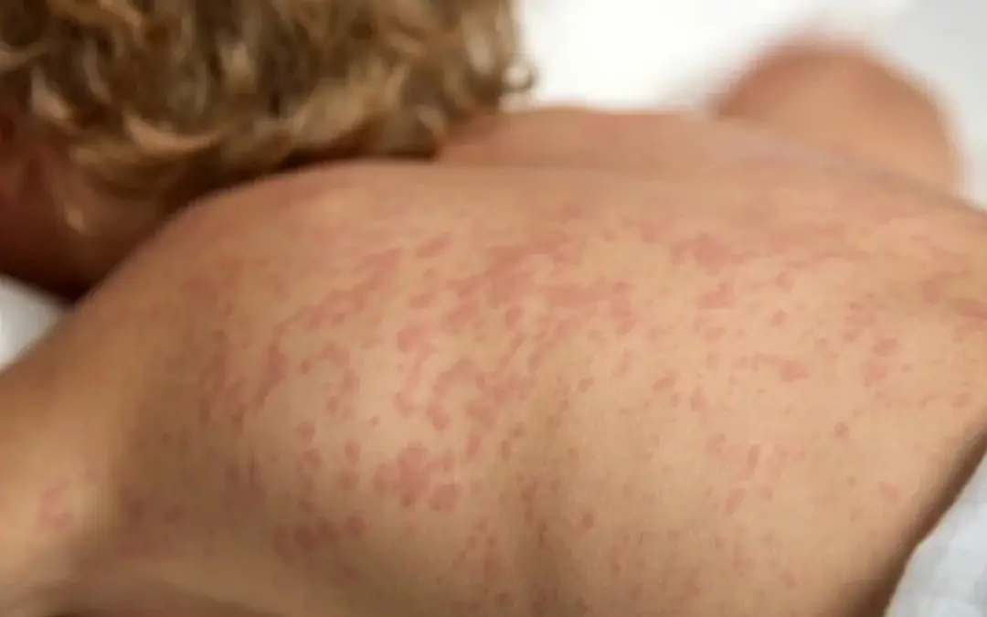 La Secretaría de Salud de Bogotá confirma un caso importado de sarampión procedente de México - Foto: Redes sociales